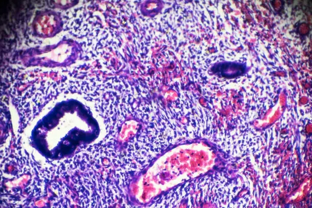 بطانة الرحم المهاجرة بالصور تحت الميكروسكوب