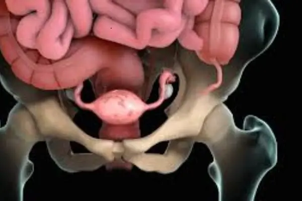 صورة تُظهر مرض بطانة الرحم المهاجرة في المثانة:
