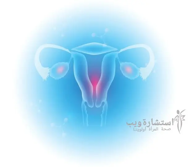 متلازمة تكيس المبايض (PCOS: polycystic ovary syndrome)